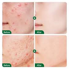 Fort Skin Clearing Serum – Acne, Pimples & Dark Spots Remover
